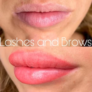 tratamiento labios antes y después